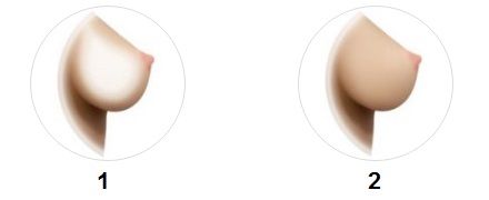 Breast type Breast type